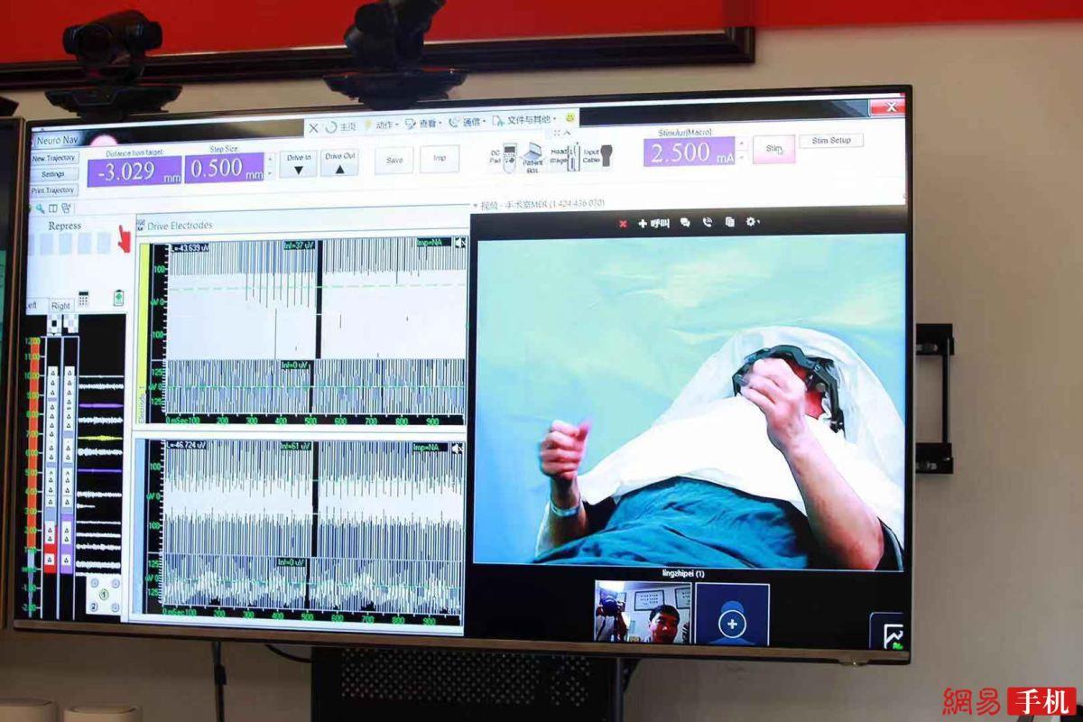 China realizó su primera incorporación de cirugía cerebral remota 5G con Huawei China realizó su primera incorporación de cirugía cerebral remota 5G con Huawei